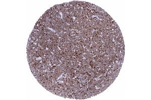 B CLL with strong ZAP70 staining of tumor cells and even stronger staining in interspersed normal T lymphocytes (Rekombinanter ZAP70 Antikörper  (AA 247-382))