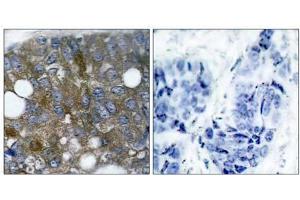 Immunohistochemical analysis of paraffin- embedded human breast carcinoma tissue using HSP27 (phospho-Ser15) antibody (E011164). (HSP27 Antikörper  (pSer15))