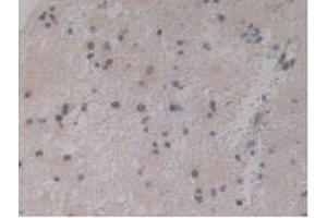 IHC-P analysis of Human Glioma Tissue, with DAB staining. (IGFBPI Antikörper  (AA 36-235))