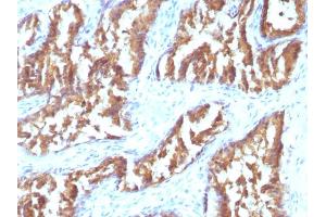 Formalin-fixed, paraffin-embedded human Prostate Carcinoma stained with IDH1 Mouse Monoclonal Antibody (IDH1/1152). (IDH1 Antikörper  (AA 281-414))