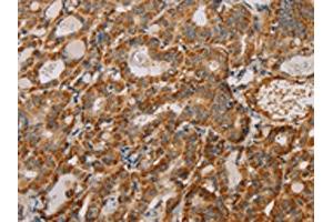 The image on the left is immunohistochemistry of paraffin-embedded Human thyroid cancer tissue using ABIN7130292(MTFR1 Antibody) at dilution 1/40, on the right is treated with fusion protein. (MTFR1 Antikörper)