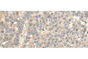 Immunohistochemistry of paraffin-embedded Human liver cancer tissue using CASQ1 Polyclonal Antibody at dilution of 1:100(x200) (Calsequestrin Antikörper)