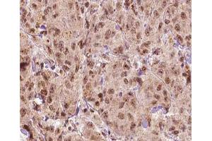 ABIN6266879 at 1/100 staining human Breast carcinoma tissue sections by IHC-P. (MAGEA1 Antikörper  (C-Term))