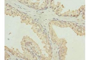 Immunohistochemistry of paraffin-embedded human prostate cancer using ABIN7167501 at dilution of 1:100 (PTPRB Antikörper  (AA 1758-1997))