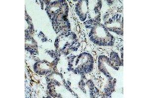 Immunohistochemical analysis of Survivin staining in human colon cancer formalin fixed paraffin embedded tissue section. (Survivin Antikörper)