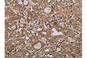 The image on the left is immunohistochemistry of paraffin-embedded Human thyroid cancer tissue using ABIN7192692(STMN2/STMN3/STMN4 Antibody) at dilution 1/45, on the right is treated with synthetic peptide. (STMN2/STMN3/STMN4 Antikörper)