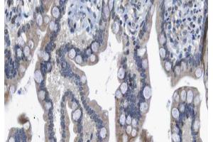 ABIN6266560 at 1/100 staining human colon carcinoma tissue sections by IHC-P. (HDAC7 Antikörper  (Internal Region))
