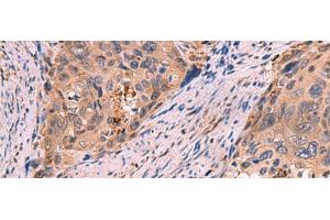 Immunohistochemistry of paraffin-embedded Human cervical cancer tissue using SHC4 Polyclonal Antibody at dilution of 1:85(x200) (SHC4 Antikörper)