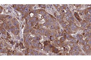 ABIN6277708 at 1/100 staining Human liver cancer tissue by IHC-P.