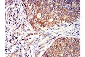 Immunohistochemical analysis of paraffin-embedded cervical cancer tissues using CD53 mouse mAb with DAB staining.