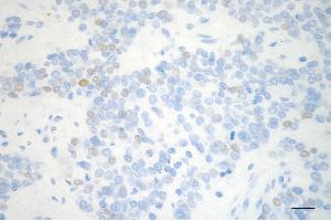 Immunohistochemistry was performed on paraffin-embedded human breast carcinoma using cyclin e2 antibody (ABIN7798199), 1:200). (Rekombinanter Cyclin E2 Antikörper)