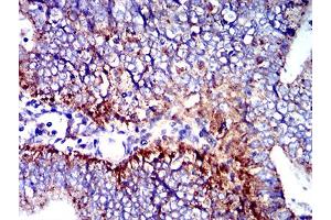 Immunohistochemical analysis of paraffin-embedded endometrial cancer tissues using CD107b mouse mAb with DAB staining. (LAMP2 Antikörper  (AA 29-168))