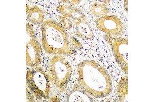 Immunohistochemical analysis of BCAR3 staining in human colon cancer formalin fixed paraffin embedded tissue section. (BCAR3 Antikörper  (C-Term))