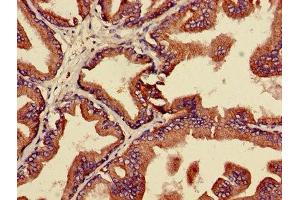 IHC image of ABIN7159999 diluted at 1:600 and staining in paraffin-embedded human prostate cancer performed on a Leica BondTM system.