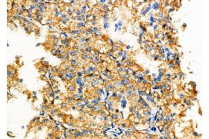 ABIN6262010 and ABIN6277327 at 1/100 staining Human kidney cancer by IHC-P.
