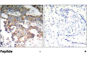 Immunohistochemical analysis of paraffin-embedded human breast carcinoma tissue using NFKBIE polyclonal antibody . (NFKBIE Antikörper)
