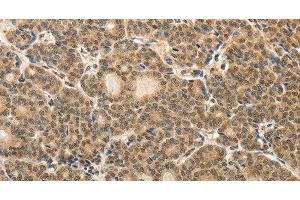 Immunohistochemistry of paraffin-embedded Human thyroid cancer tissue using MAP1A Polyclonal Antibody at dilution 1:40 (MAP1A Antikörper)