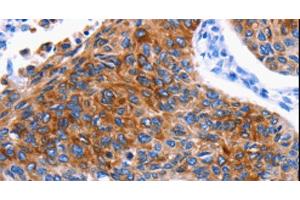 Immunohistochemistry of paraffin-embedded Human lung cancer using DRD4 Polyclonal Antibody at dilution of 1:30 (DRD4 Antikörper)
