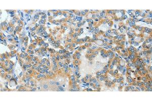 Immunohistochemistry of paraffin-embedded Human thyroid cancer using BAAT Polyclonal Antibody at dilution of 1:30 (BAAT Antikörper)