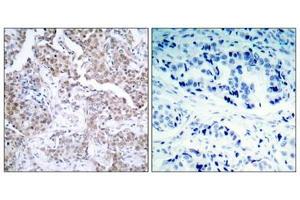 Immunohistochemical analysis of paraffin-embedded human breast carcinoma tissue using p53 (Phospho-Ser15) Antibody (left) or the same antibody preincubated with blocking peptide (right). (p53 Antikörper  (pSer15))