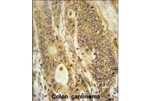 AVIL Antibody (N-term) (ABIN650952 and ABIN2840008) immunohistochemistry analysis in formalin fixed and paraffin embedded human colon carcinoma followed by peroxidase conjugation of the secondary antibody and DAB staining. (Advillin Antikörper  (N-Term))