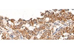 Immunohistochemistry of paraffin-embedded Human ovarian cancer tissue using CA5B Polyclonal Antibody at dilution of 1:65(x200) (CA5B Antikörper)