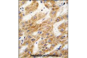 Formalin-fixed and paraffin-embedded human hepatocarcinoma tissue reacted with ALDH4A1 antibody , which was peroxidase-conjugated to the secondary antibody, followed by DAB staining. (ALDH4A1 Antikörper  (C-Term))