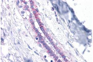Immunohistochemistry (Formalin-fixed Paraffin-embedded Sections) (IHC (fp)) image for anti-Cadherin 1, Type 1, E-Cadherin (Epithelial) (CDH1) (AA 503-552) antibody (ABIN6745747)