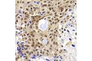 Immunohistochemistry of paraffin-embedded human oophoroma using PHF19 antibody (ABIN5975738) at dilution of 1/100 (40x lens). (PHF19 Antikörper)