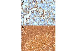 Immunohistochemical staining (Formalin-fixed paraffin-embedded sections) of human histiocytoma (A) and human tonsil (B) with HLA-DRB1 monoclonal antibody, clone HLA-DRB/1067 . (HLA-DRB1 Antikörper)