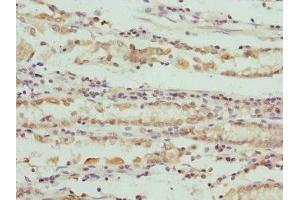 Immunohistochemistry of paraffin-embedded human gastric cancer using ABIN7166101 at dilution of 1:100 (SCO2 Antikörper  (AA 1-130))
