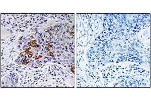 Immunohistochemistry analysis of paraffin-embedded human lung carcinoma tissue, using ADCY9 antibody. (ADCY9 Antikörper)