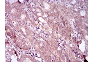 Immunohistochemical analysis of paraffin-embedded cervical cancer tissues using EGFR mutant mouse mAb with DAB staining. (EGFR Mutant (AA 693-893), (Mutant) Antikörper)