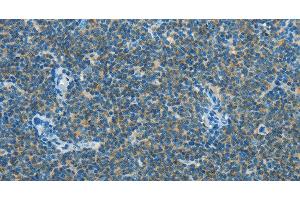 Immunohistochemistry of paraffin-embedded Human lymphoma using CAV3 Polyclonal Antibody at dilution of 1:30 (Caveolin 3 Antikörper)