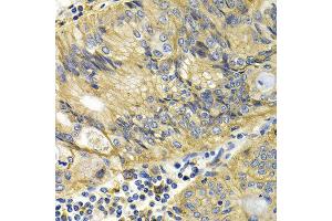 Immunohistochemistry of paraffin-embedded human colon cancer using KLKB1 antibody at dilution of 1:200 (400x lens). (KLKB1 Antikörper)