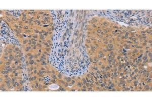Immunohistochemistry of paraffin-embedded Human cervical cancer using BRS3 Polyclonal Antibody at dilution of 1:50 (BRS3 Antikörper)