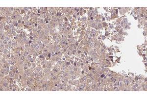 ABIN6275975 at 1/100 staining Human liver cancer tissue by IHC-P. (PTH1R Antikörper  (pThr1))
