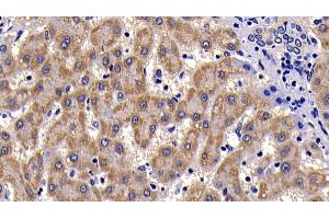 Detection of SAA in Human liver cirrhosis Tissue using Polyclonal Antibody to Serum Amyloid A (SAA) (SAA Antikörper  (AA 19-122))