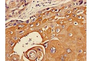 Immunohistochemistry of paraffin-embedded human ovarian cancer using ABIN7174048 at dilution of 1:100 (TIE1 Antikörper  (AA 217-328))