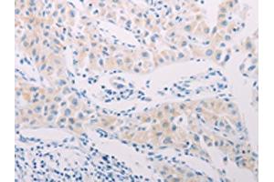 The image on the left is immunohistochemistry of paraffin-embedded Human lung cancer tissue using ABIN7189656(ADAMTS17 Antibody) at dilution 1/60, on the right is treated with synthetic peptide. (ADAMTS17 Antikörper)