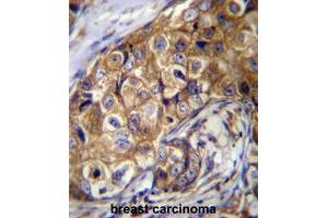 CTAGE5 Antibody (C-term) immunohistochemistry analysis in formalin fixed and paraffin embedded human breast carcinoma followed by peroxidase conjugation of the secondary antibody and DAB staining. (MIA2 Antikörper  (C-Term))