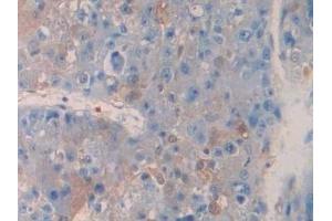 Detection of TNFRSF12A in Human Liver cancer Tissue using Polyclonal Antibody to Tumor Necrosis Factor Receptor Superfamily, Member 12A (TNFRSF12A) (TNFRSF12A Antikörper  (AA 24-126))