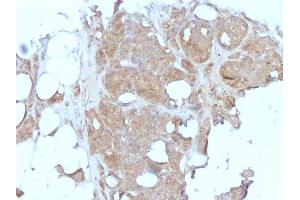 Formalin-fixed, paraffin-embedded human Breast Carcinoma stained with MVP Monoclonal Antibody (1032). (MVP Antikörper)