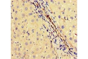 Immunohistochemistry of paraffin-embedded human liver cancer using ABIN7174393 at dilution of 1:100 (OTUB1 Antikörper  (AA 2-201))