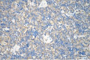 Immunohistochemistry was performed on paraffin-embedded human lymphoma using ARHGEF1 antibody (ABIN7800200), 1:200).
