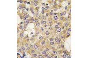 Formalin-fixed and paraffin-embedded human breast carcinoma tissue reacted with Parg antibody (C-term) , which was peroxidase-conjugated to the secondary antibody, followed by DAB staining. (PARG Antikörper  (C-Term))