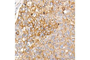 Immunohistochemistry of paraffin-embedded human esophageal cancer using PLOD3 Rabbit mAb (ABIN7269530) at dilution of 1:1600 (40x lens).