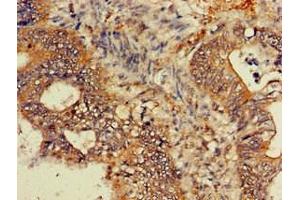 Immunohistochemistry of paraffin-embedded human colon cancer using ABIN7154741 at dilution of 1:100