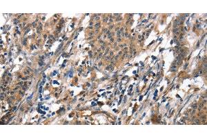 Immunohistochemistry of paraffin-embedded Human gasrtic cancer tissue using ALOX15 Polyclonal Antibody at dilution 1:50 (ALOX15 Antikörper)