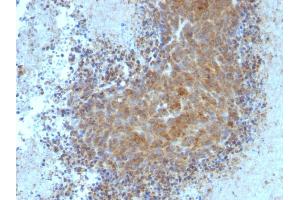 Formalin-fixed, paraffin-embedded human Melanoma stained with BAX Mouse Monoclonal Antibody (BAX/962). (BAX Antikörper)